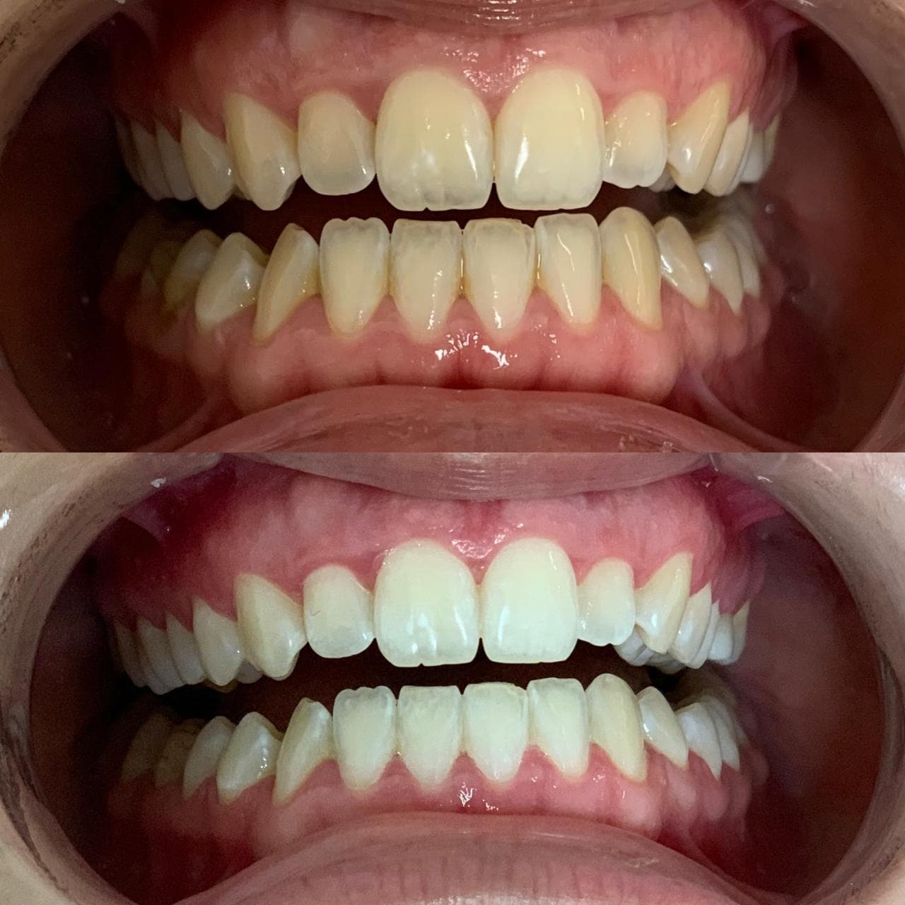 Blanqueamiento Dental